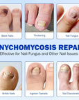Nighttime Renewal Fungal Nail Patches