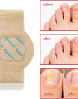 Nighttime Renewal Fungal Nail Patches