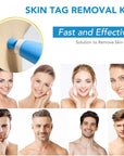 MicroCare Skin Solution - Advanced Skin Tag, Wart, Acne, and Pimple Removal Kit