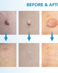 MicroCare Skin Solution - Advanced Skin Tag, Wart, Acne, and Pimple Removal Kit