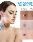 MicroCare Skin Solution - Advanced Skin Tag, Wart, Acne, and Pimple Removal Kit