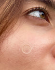 Microdarts Acne Patches (Instant acne treatment)