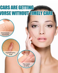 Silicone Scar Medical Skin Care & Pimples Removel Tape
