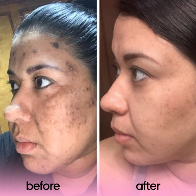 TURMERIC &amp; KOJIC ACID PADS